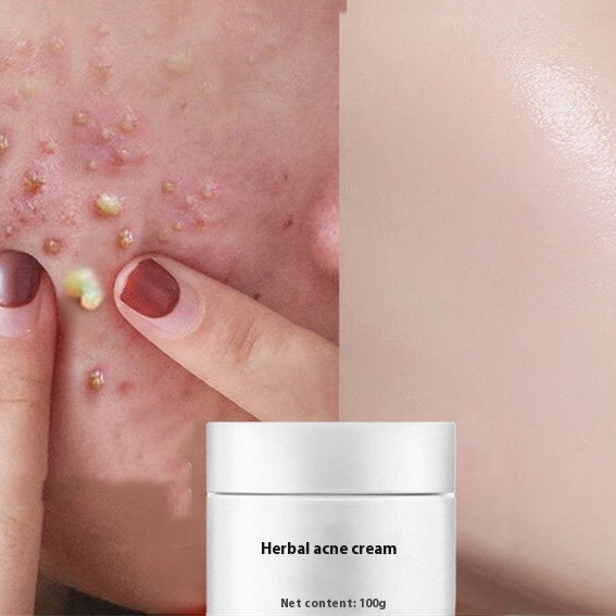 Herbal acne lightening cream, 100g